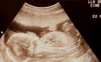 做人工授精可以选择双胎和试管双胎有什么区别？