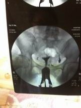 试管婴儿三代养囊后移植的是冻囊胚还是鲜囊胚？